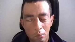 Paralisis facial