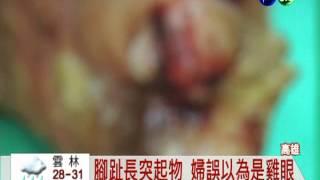 婦人腳底長疣 腳掌潰爛險罹癌