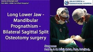 Long Lower Jaw - Mandibular Prognathism - Bilateral Sagittal Split Osteotomy surgery