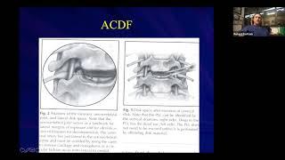 Cervical Radiculopathy: Natural History, Pathophysiology, and Treatment Options