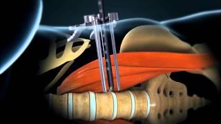 LLIF (Lateral Lumbar Interbody Fusion) -- Larry Parker M.D.