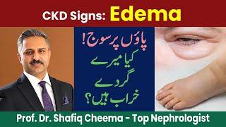 CKD Sign No 2 : Edema or Leg Swelling, Causes & Treatment