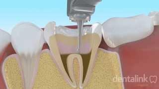 Endodoncia completa PASO A PASO - Video 3D