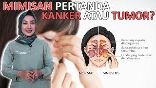 Ternyata Ini Cara Cepat Atasi Mimisan