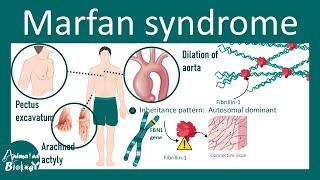 Marfan Syndrome | Pathophysiology, Diagnosis, Management | USMLE STEP1