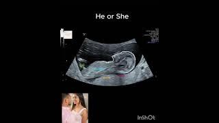 #gynaecology #usg#babygirl #babyboy  @DrSudarshanlipane ️🩺‍️