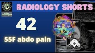 55F Abdo Pain - CT abdo | CTBUZZ2022 || #radiologyresident #radiology  | nobakbak | radiologyshorts