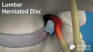 Lumbar Herniated Disc Overview