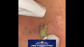 Steatocytoma Multiplex In A Black Head Cluster / Cyst Removal / Acne / Blackheads