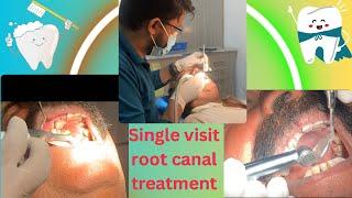 Single visit root canal #dental #dentistry #smile #umair toothfairy @Umairazeem8553