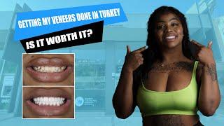 GETTING MY VENEERS DONE IN TURKEY - IS IT WORTH IT? #veneersturkey #teethturkey