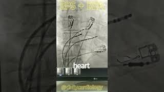 EPS RFA PROCEDURE | TREATMENT #shorts #cardiology