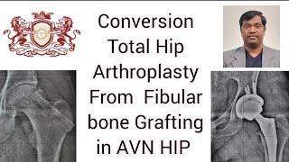 conversion Total Hip Replacement from fibular bone grafting #Drs.k Sharma M.S Ortho #Surya Ortho