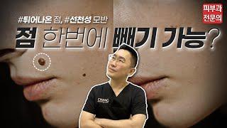 점 빼려고 하는 분들 필수 시청! - 튀어나온 점, 선천성 모반 |피부과전문의 닥터창|