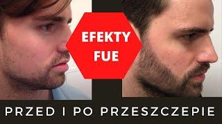 Przed i po przeszczep włosów EFEKTY. Przeszczep FUE