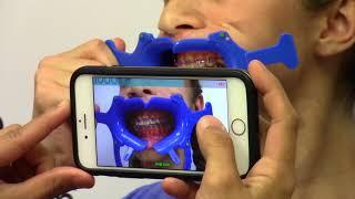 Orthodontic Specialist of Lake County | Braces with Partner Training Dental Monitoring Video