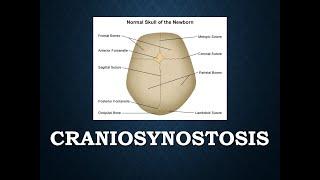 Craniosynostosis - an overview