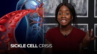 Sickle Cell Crisis:  Causes, Symptoms, and Prevention Strategies