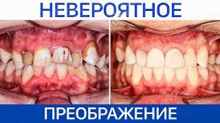 ОТ кривых зубов ДО голливудской улыбки — НЕВЕРОЯТНОЕ ПРЕОБРАЖЕНИЕ!