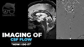 IMAGING OF CSF FLOW – “HOW I DO IT”