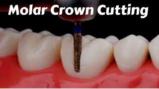 Posterior molar Crown #Tooth_Preparation Cutting For PFM Zirconia Ceramic Emax - Prostho Lecture