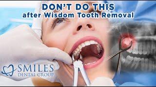 Wisdom Tooth Removal: Things You MUST Avoid! (2021)