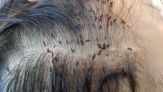 GET RID OF HEAD LICE FAST AND FOR GOOD?