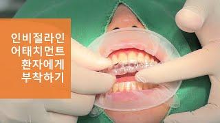 인비절라인 어태치먼트 실제 환자에게 부착과정