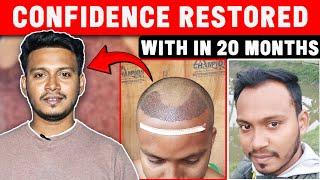 2 Years Coming Hair Transplant Result | &How  Maintain Your Hair Transplant Result For Longtime