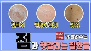 점인줄 알았니? 편평사마귀, 검버섯, 쥐젖