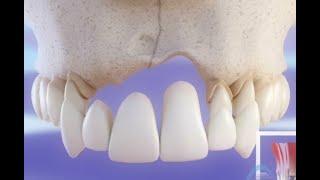 Implant dentaire vs Pont dentaire - Comparaison ©