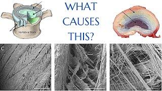 What Causes A Disc Bulge? | Herniated Disc