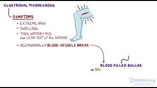 Clostridium Perfringens | Osmosis