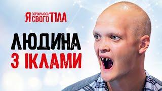 Редкая наследственная болезнь разрушает жизнь Саши – Я соромлюсь свого тіла | ЛЕЧЕНИЕ