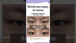 Monolid Eye Surgery for Women! Natural Transformation Plastic Surgery