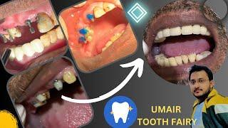 The Art of Post-Core Build-Up in Dentistry"#dental #smile  #Umairtoothfairy @Umairazeem8553