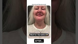 INSANE Facelift Before & After...You'll Be Speechless!