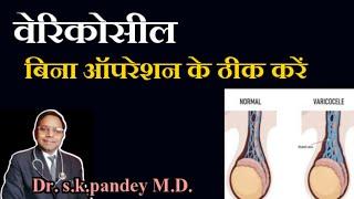 वेरिकोसील बिना ऑपरेशन ठीक करने की दवा Dr. s.k.pandey M.D.