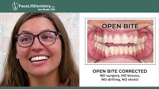 Open-Bite Fix, No Surgery or Braces, One Month