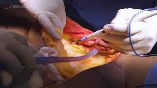 WATCH a LIVE TUMMY TUCK SURGERY with DR. NICHOLAS JONES, MD!