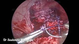 Laparoscopy-Assisted Myomectomy For Fibroid Removal | Dr. Sushmita Mukherjee