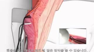 [성남 정다운산부인과] 직장항문복원술 RAR 소개 - 소음순수술, 이쁜이수술, 드림 질성형 수술법,요실금수술,요실금치료 15년 저명의 원영석 원장