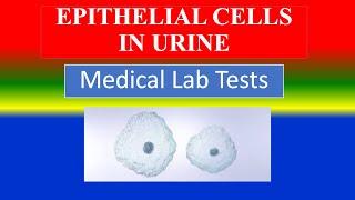 EPITHELIAL CELLS IN URINE - -   Medical  Lab Tests - What is ? ,Uses, Need ,Preparation , Results