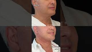 EVE Lift™ Patients Results | Eden Plastic Surgery: Dr. Ali Charafeddine, MD