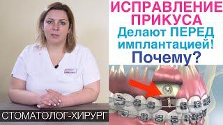 Пришел поставить зубные импланты, а мне сказали предварительно исправить прикус брекетами. Зачем?