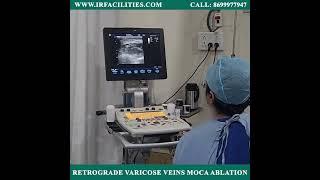 Retrograde Varicose Veins MOCA Ablation by Dr. Sandeep Sharma | IRFACILITIES
