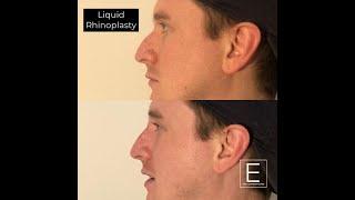 Liquid NoseJob (non-surgical rhinoplasty) with Dr Michael Aicken at East London Clinic