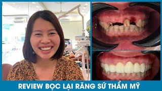 Review cách làm lại bọc răng sứ thẩm mỹ | Nhakhoaoze.com