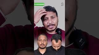 Nine Months Hair Transplant Results | Latest Fue Technique #shorts #viral #hair transplant