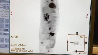 PET Scan Machine Detecting Cancer